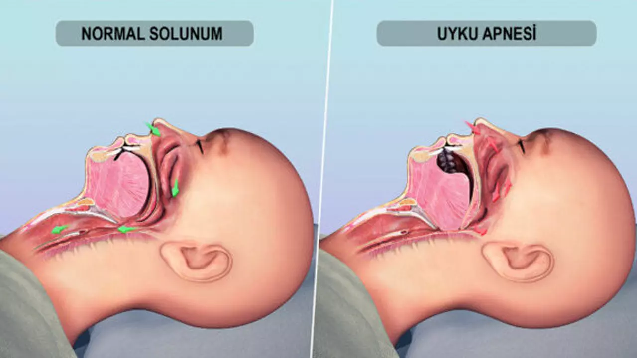 Uyku Apnesi3