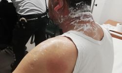 Hatay'da Demokrat Partili adayın yüzüne asit fırlatıldı: Saldırgan gözaltına alındı