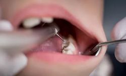 Çocuklarda diş çürüklerini engellemek mümkün mü?